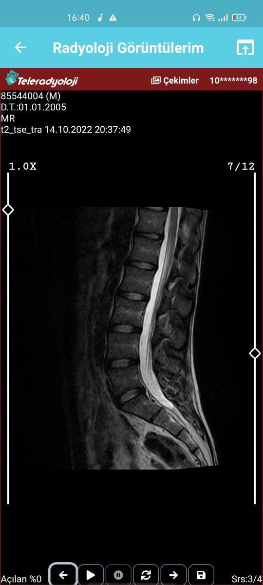 Arkadaşlar doktor bende fıtık başlangıcı war dedi ama interneten bakiyorum disklerim yerinde gözüküyor fıtık gibi durmuyor?