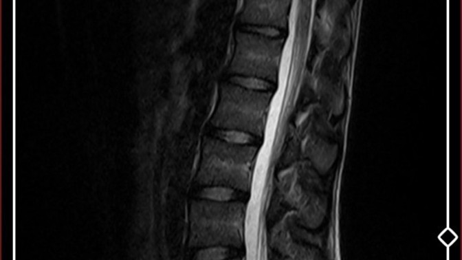 Arkadaşlar doktor bende fıtık başlangıcı war dedi ama interneten bakiyorum disklerim yerinde gözüküyor fıtık gibi durmuyor?