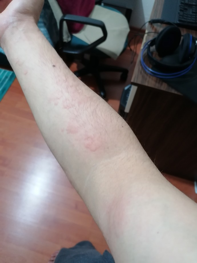 Bir şey yiyip içtikten sonra vücudumda böyle kabartılar çıkıyor, nedeni sizce nedir?