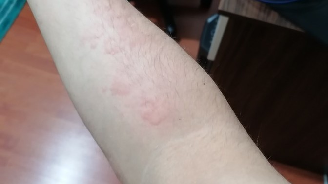 Bir şey yiyip içtikten sonra vücudumda böyle kabartılar çıkıyor, nedeni sizce nedir?