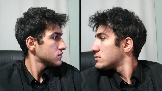 Sizce burnum büyük mü, estetik olmama gerek var mı?