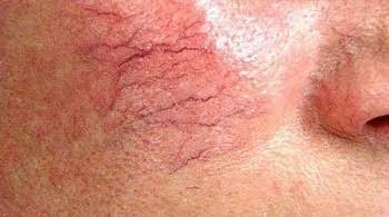 Yüzde kılcal damar çatlamasına çare bulan var miii?