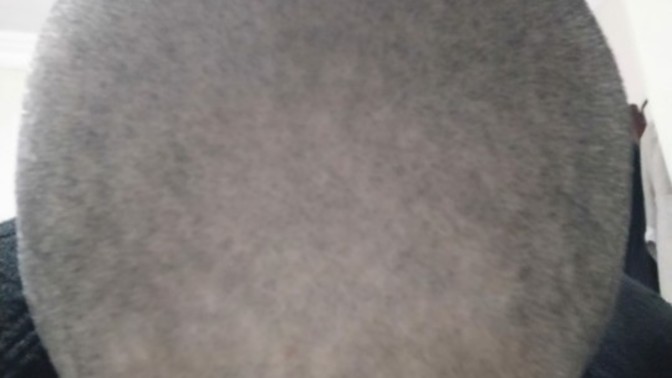 Küçükken kafama kaynar su dökülmüş yanık izi var mı sizce?