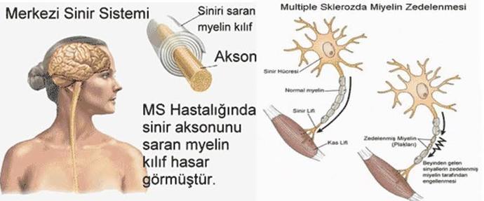 MS nedeni tam bilinmeyen myelin denen kılıfın hasar görmesidir. Bu şekilde sinirlere çeşitli zarar verir