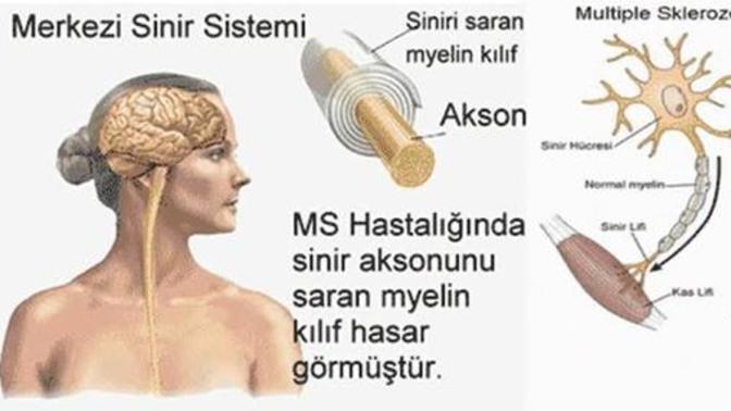 Ms hastası olan var mı ya da bilgisi olan?