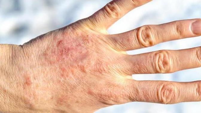 Soğuktan dolayı çatlayan ellere nasıl bakım yapılmalı?