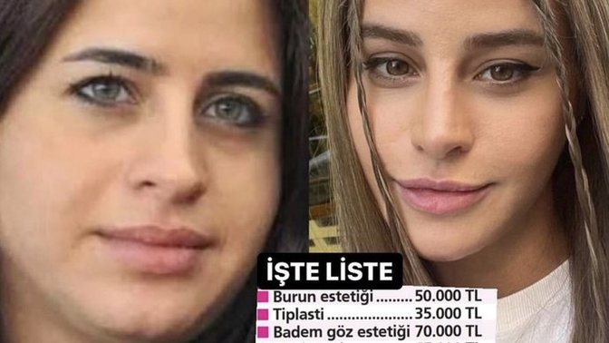 Büşra Tekin'in estetik ameliyatı 315 bin TL tuttu, estetik yaptıracak olsan ne kadar tutar?