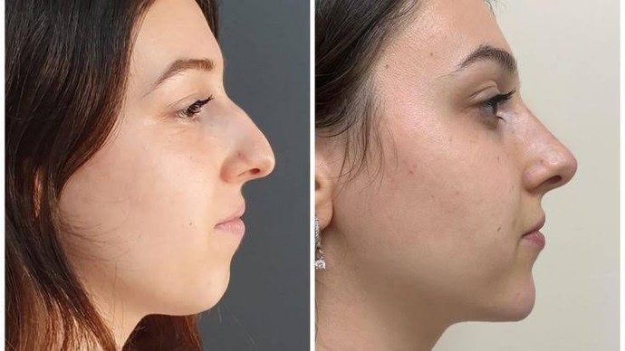 Çevrenizde burun dolgusu olan insanlar var mı, memnunlar mı?