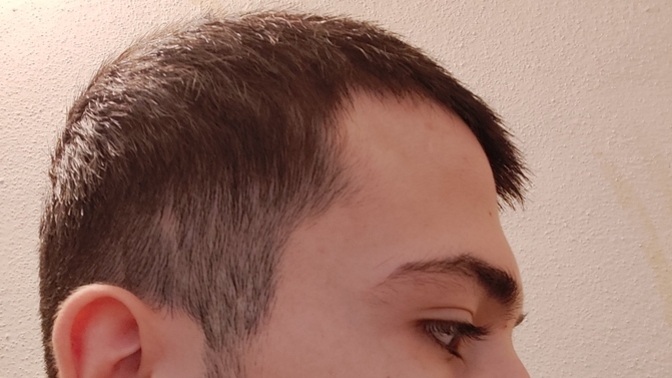 Yanlarda dökülme var gibi bilgisi olanlar var mı?