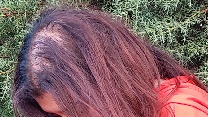 Arkdaslar saçım fotograftaki gibi dökülüyor ne yapmam lazım bilmiyorum daha çok açıldı diplerim?