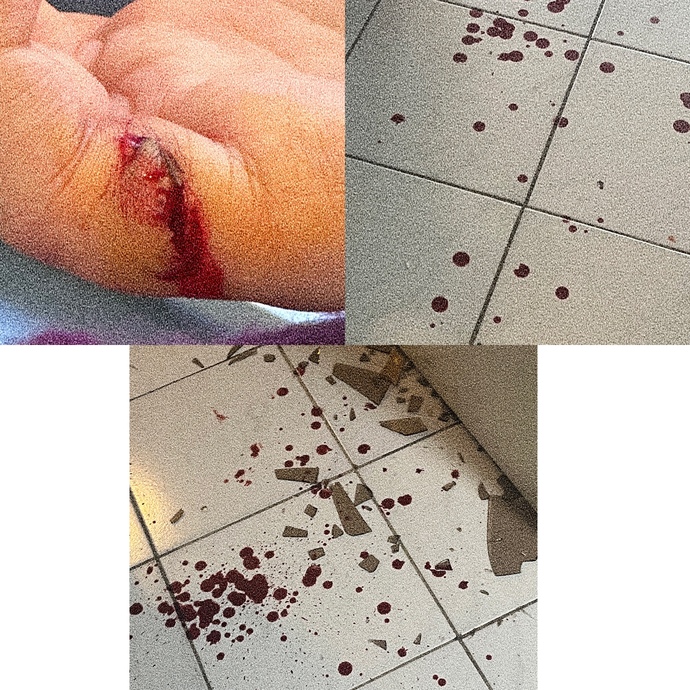 Bu kesiğin bu kadar kanaması normal mi?