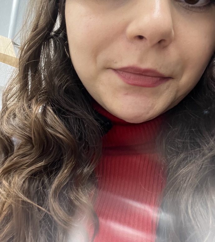 Nazolabial çizgilere 0,5+0,5 dolgu yaptırdım, yüzüm yuvarlak görünüyor. Geçer mi?