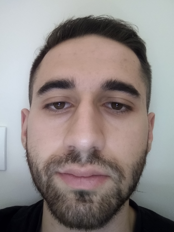 Alnım ve vücudumda yağlı sivilceler çıkıyor, ne yapmam gerekiyor?