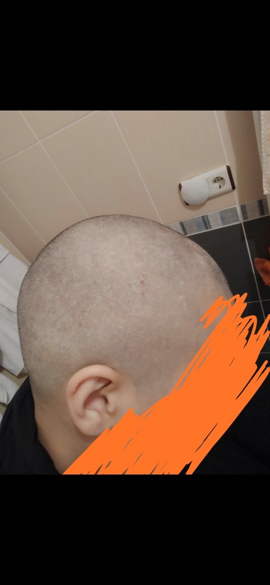 Kafada yanık izi var mı?