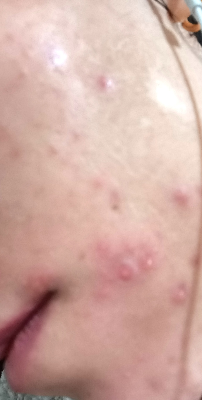 Dermapen sorunsalı sizce normal mi?