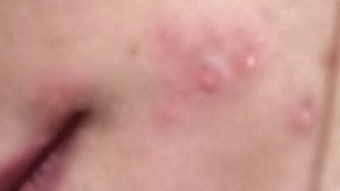 Dermapen sorunsalı sizce normal mi?