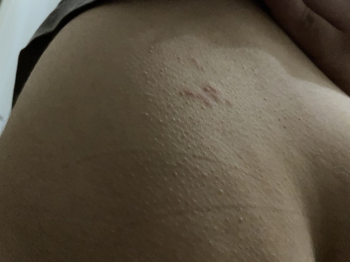Dün ufak birseydi bugun büyüdü aşırı kaşınıyor tüm bölgeye yayıldı kaşıntı uyuz olabilirmi?