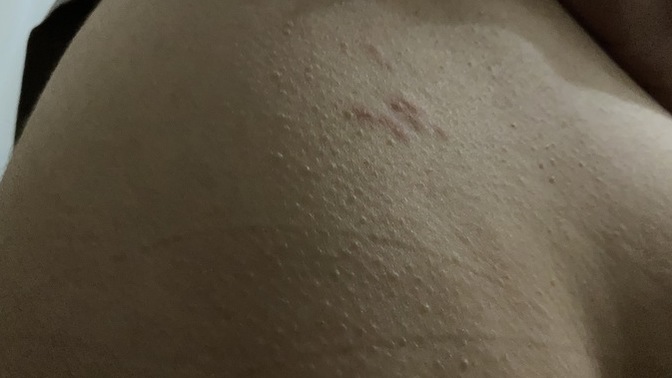 Dün ufak birseydi bugun büyüdü aşırı kaşınıyor tüm bölgeye yayıldı kaşıntı uyuz olabilirmi?