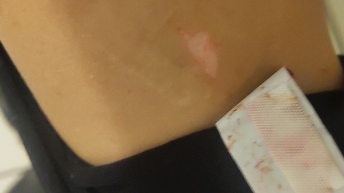 RESLİMLİ bacağınızı alırken jilet izi oldu mu hiç, olduysa geçti mi?