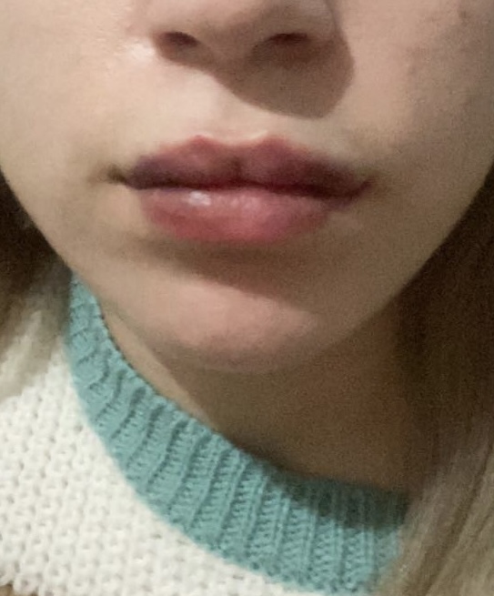 Dudaklarım nasıl olmuş?