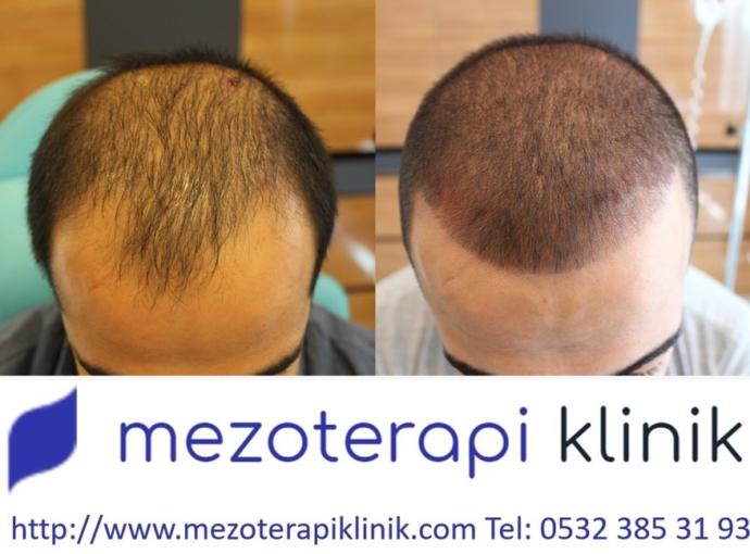 Saç Mezoterapisi ve Kök Hücre Tedavisi Hakkında?