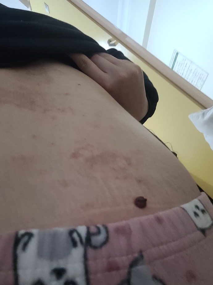 Vucudunda cok leke olan birini sevebilir misiniz (Resimli) ?