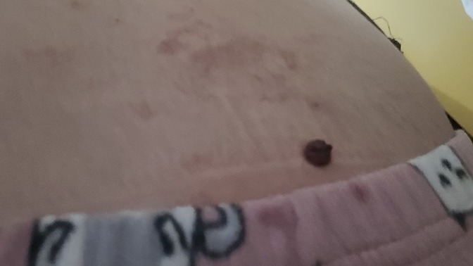 Vucudunda cok leke olan birini sevebilir misiniz (Resimli) ?
