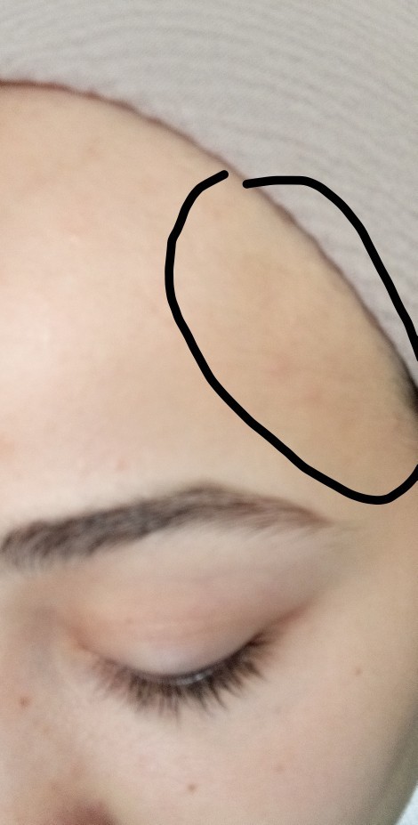 Alnıma lazer yerine ağda yapsam, zarar verir mi?