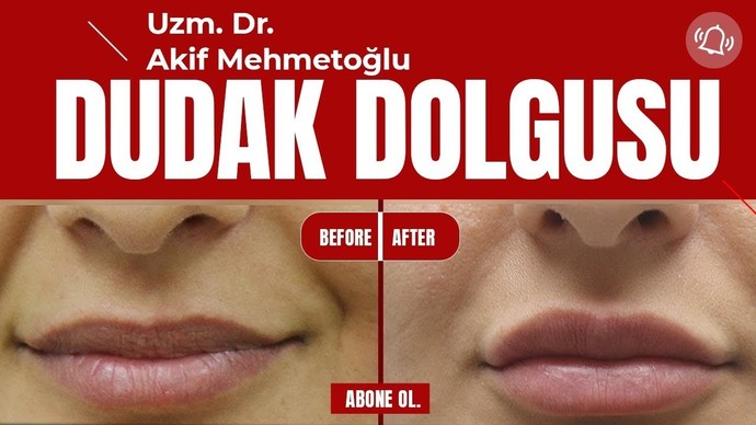 Erkekler dolgu dudağı beğeniyor mu?