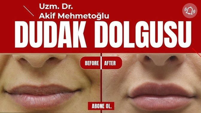 Erkekler dolgu dudağı beğeniyor mu?