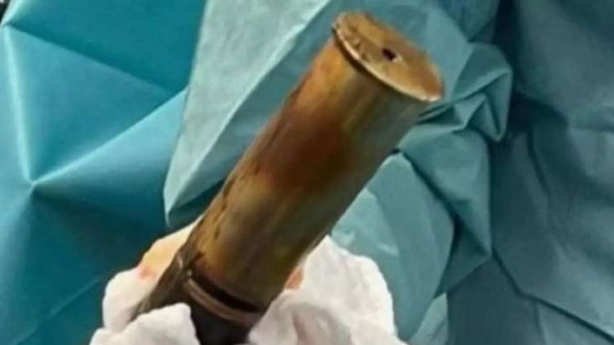 Hastanın rektumuna top mermisi sıkışınca hastane tahliye edildi! Başınıza gelen veya şahit olduğunuz en absürt sağlık olayı nedir?