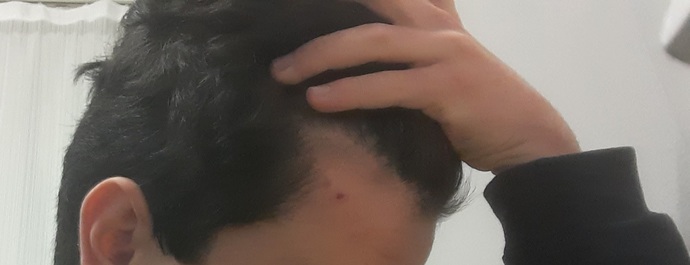 18 yaşındayım, kellikten aşırı korkuyorum. Saçlarım normal mi?