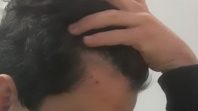 18 yaşındayım, kellikten aşırı korkuyorum. Saçlarım normal mi?
