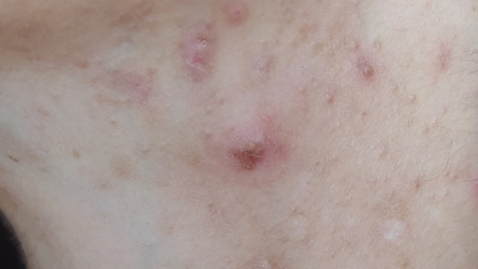 Bunlar egzama mı, gül hastalığı mı yoksa sivilce mi?