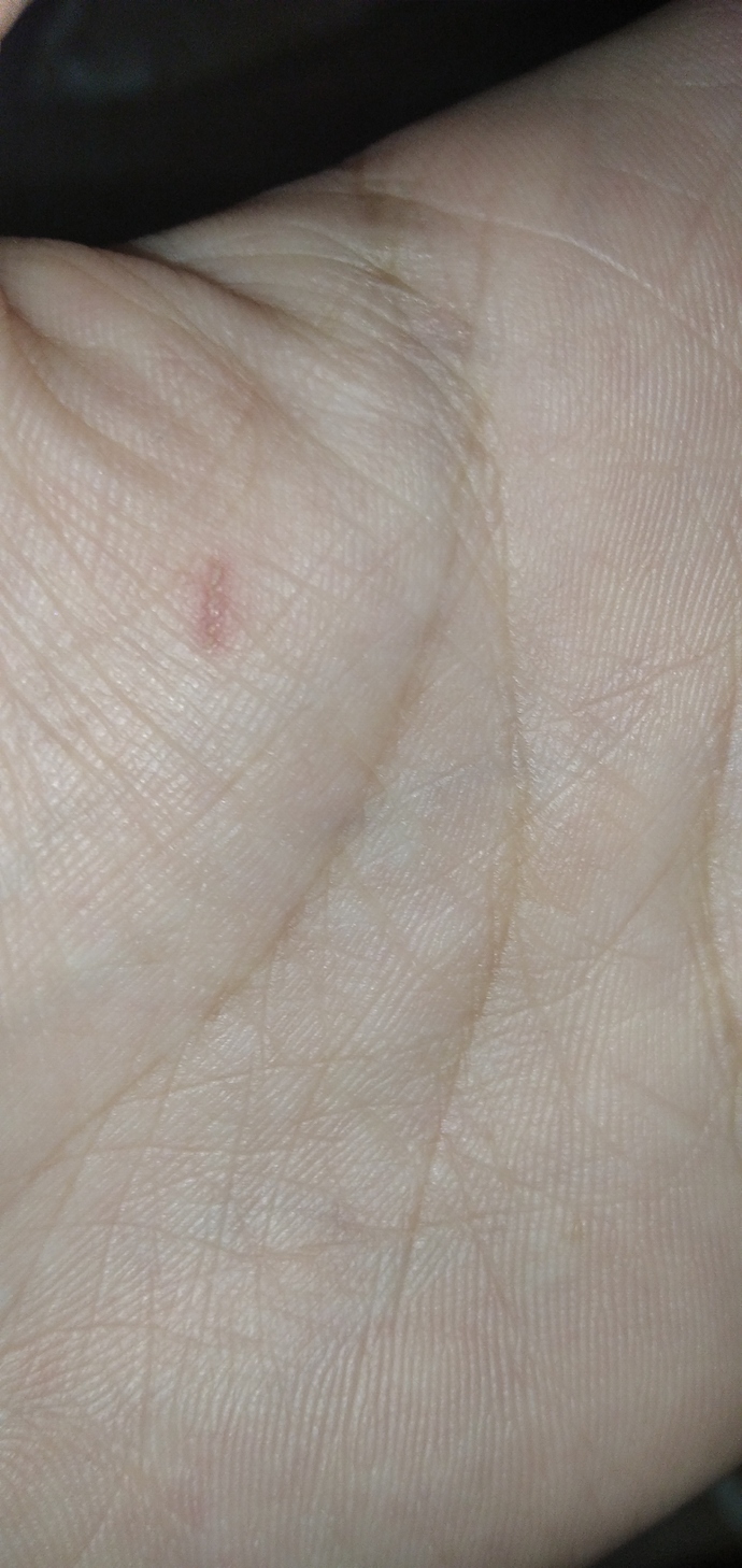 Sabahları uyandığımda elimde bu tür çizikler oluşuyor sebebi be olabilir gün içerisinde yok ama uyandığımda var?