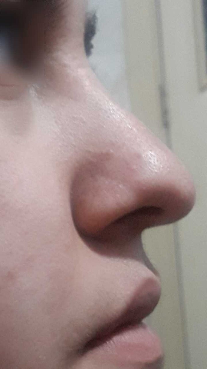 Herkes burnuna estetik yaptırıyor. Benim de yaptırmama gerek var mı?