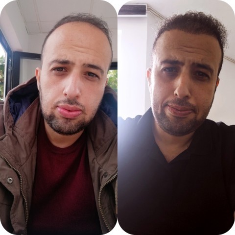 6 aylık saç ekimim nasıl olmuş?