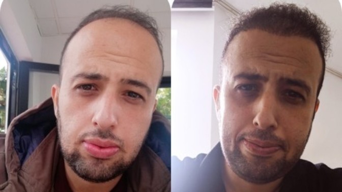 6 aylık saç ekimim nasıl olmuş?