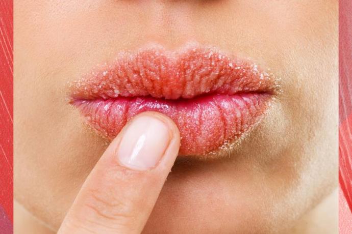 Dudak kurumasına çözüm (roaccutane)?