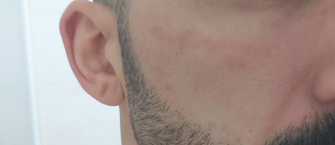 Neutrogena canlandırıcı günlük peeling jel kullandım sürdüğüm yerler kızardı normal mi?