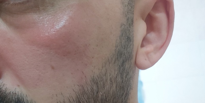 Neutrogena canlandırıcı günlük peeling jel kullandım sürdüğüm yerler kızardı normal mi?