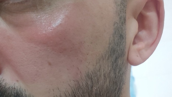Neutrogena canlandırıcı günlük peeling jel kullandım sürdüğüm yerler kızardı normal mi?
