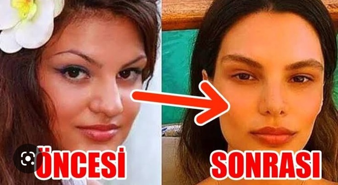 Burun estetiği bir insanı ne kadar değiştirebilir, gördüğünüzde vay be dediğiniz biri oldu mu?