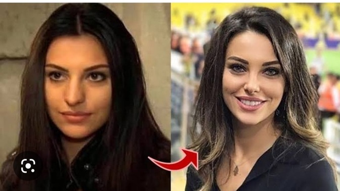 Burun estetiği bir insanı ne kadar değiştirebilir, gördüğünüzde "vay be" dediğiniz biri oldu mu?