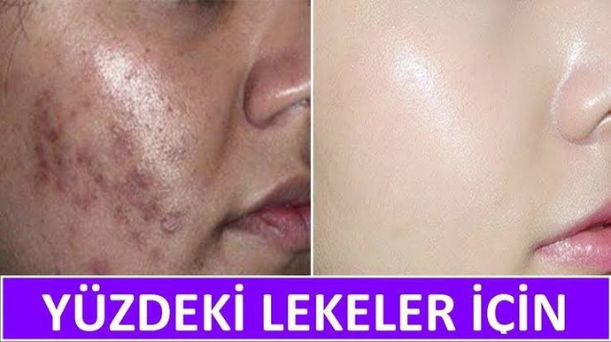 Cilt lekelerini gidermek için en iyi yöntem nedir?