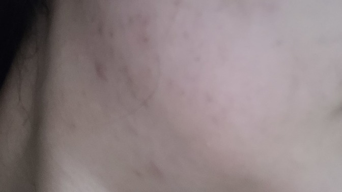 Sivilce lekeleri için ne kullanıyorsunuz?