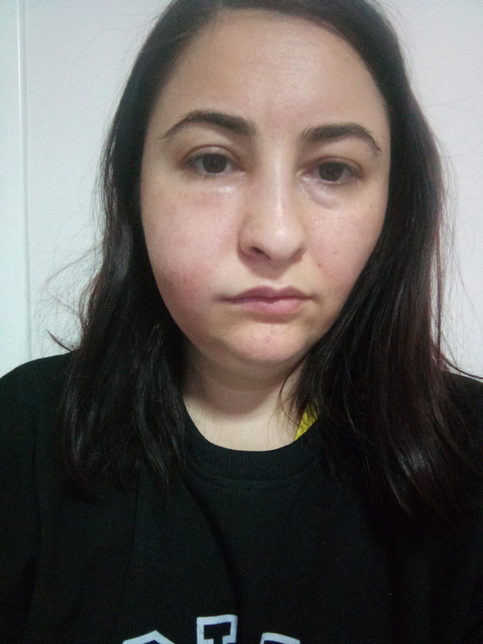 Yanağımın içinde aft çıktı. Nasıl geçer bu?