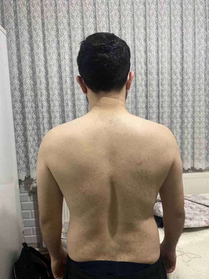 Sırtımdaki 15 günlük gelişme nasıl?