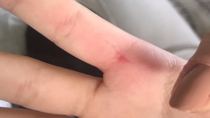 Parmağım kapıya sıkıştı, böyle kan topladı. Normal mi sizce?