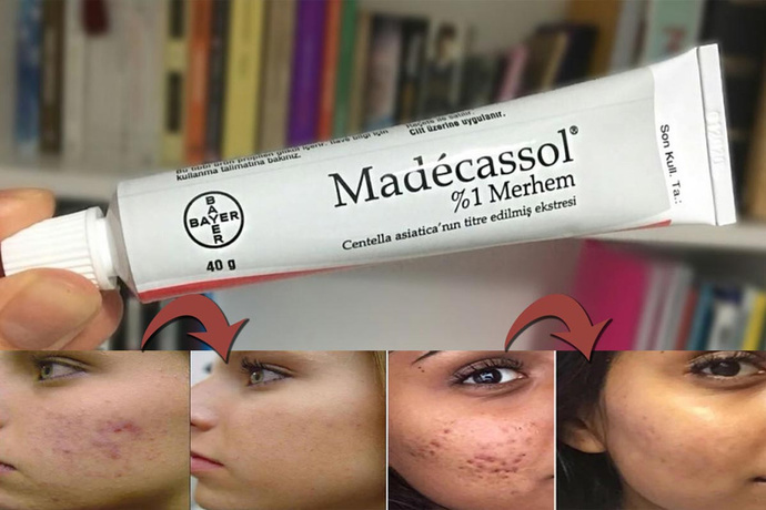Madecassol krem nasıl kullanılmalı? Kortizon içeriyor mu?